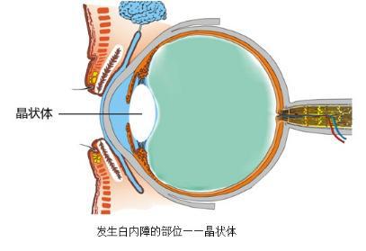 白内障是怎么引起的